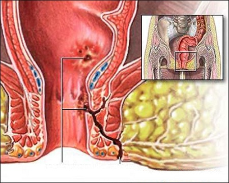 bệnh rò hậu môn và cách chữa trị hiệu quả