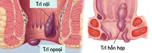 Khó đi cầu- Biểu hiện của bệnh trĩ