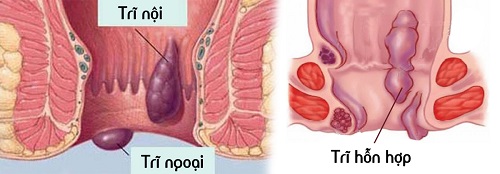 Bệnh trĩ