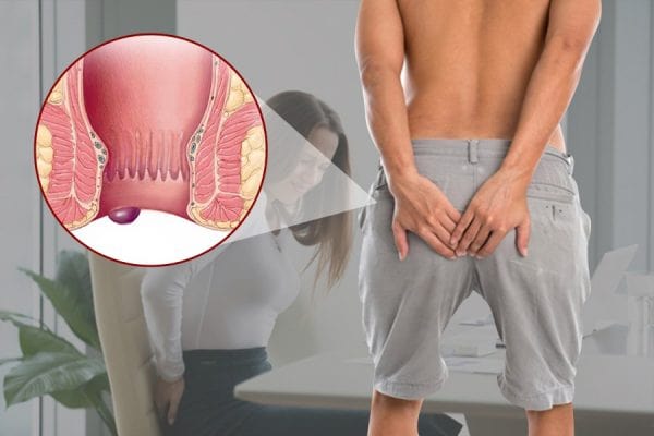 Bệnh trĩ cần được chữa trị càng sớm càng tốt!