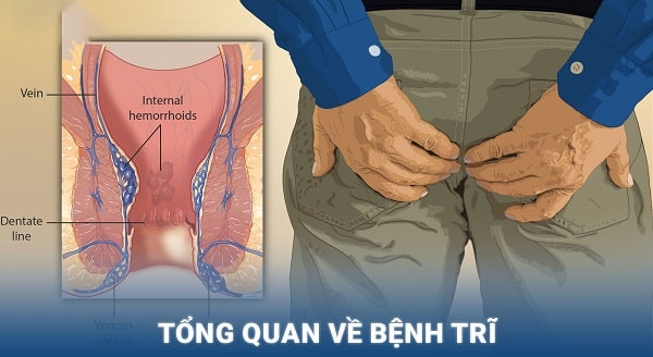 Những thông tin tổng quát về bệnh trĩ
