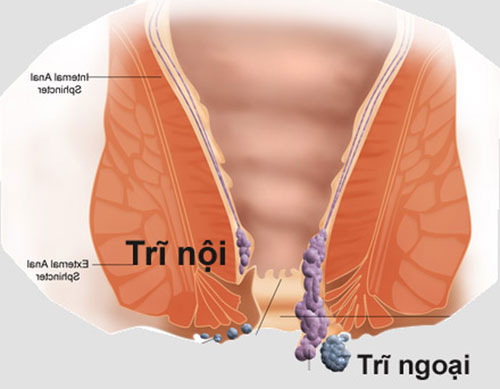 Biểu hiện của bệnh trĩ