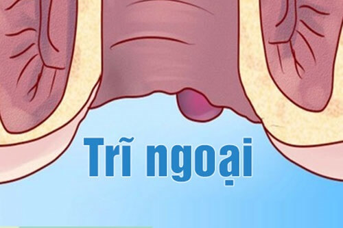 Hình ảnh minh họa trĩ ngoại