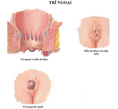 Trĩ ngoại là căn bệnh liên quan đến vùng hậu môn - trực tràng