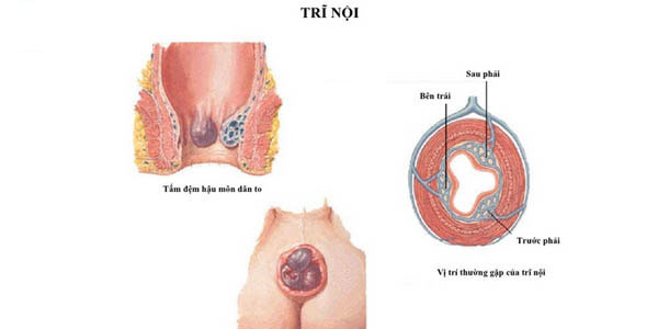 Hình ảnh minh họa bệnh trĩ nội