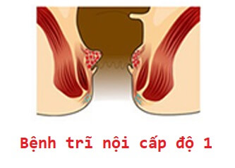 Bệnh trĩ nội cấp độ 1