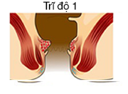 Bệnh trĩ nội độ 1 là 1 trong 4 giai đoạn của trĩ nội