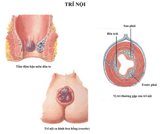 Dấu hiệu nhận biết bệnh trĩ nội