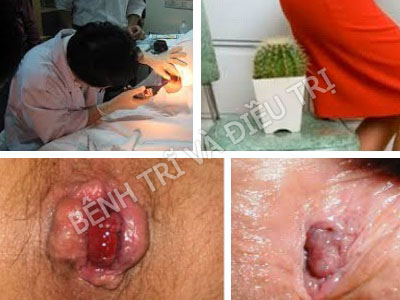bệnh trĩ cấp độ 4 và cách điều trị