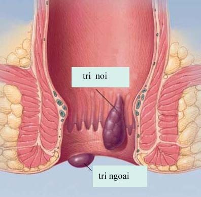 Táo bón là dấu hiệu bệnh trĩ 