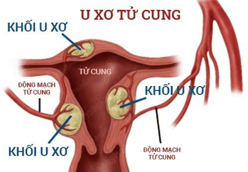 bệnh u xơ tử cung