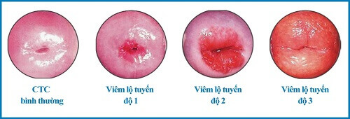 Bệnh viêm lộ tuyến cổ tử cung
