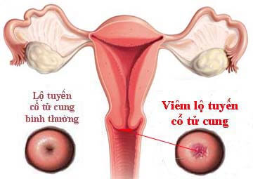 Khí hư trắng đục bột do viêm lộ tuyến cổ tử cung