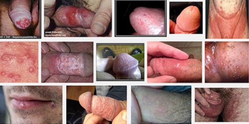 Bệnh viêm nhiễm nam khoa 
