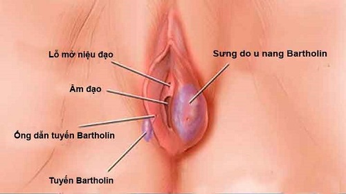 Hình ảnh bệnh viêm tuyến bartholin