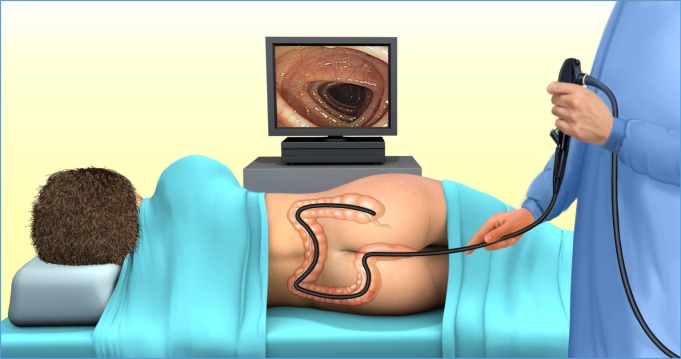 Những điều cần biết về nội soi đại tràng