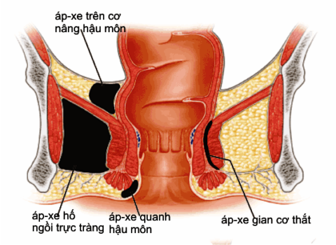 tác hại áp xe hậu môn gây ra