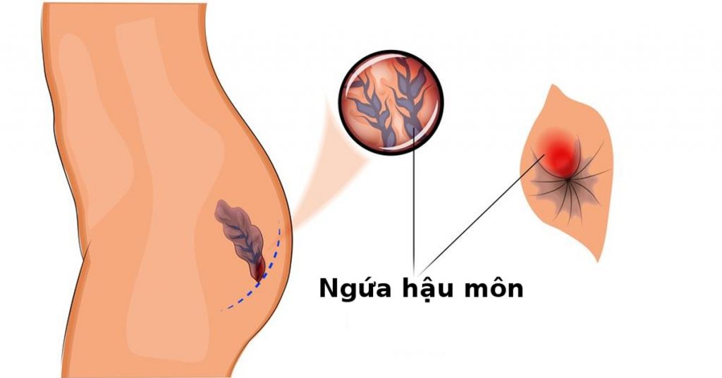biến chứng ngứa rát hậu môn ảnh hưởng gì