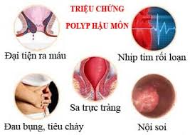 những biến chứng áp xe hậu môn gây ra