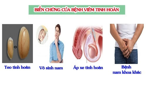 Biến chứng viêm tinh hoàn nguy hiểm nếu không phát hiện và điều trị kịp thời 