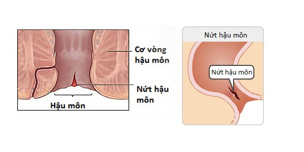 Biểu hiện bệnh nứt kẽ hậu môn