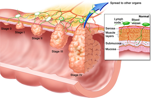 Biểu hiện bệnh polyp hậu môn