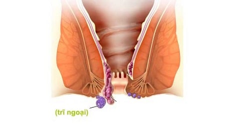 Biểu hiện trĩ ngoại độ 1 như thế nào ?