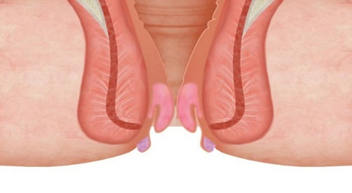 Búi trĩ là phần thịt thừa bị lòi ra khỏi hậu môn