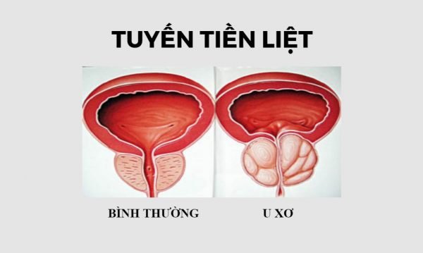 Bệnh về tuyến tiền liệt