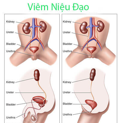 Các bệnh nam khoa thường gặp: viêm niệu đạo