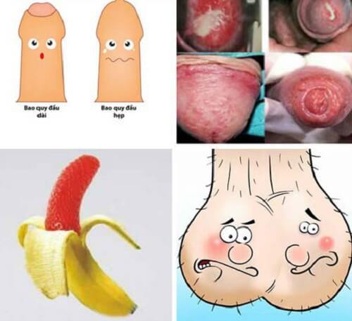 Các bệnh về bộ phận sinh dục của nam giới 