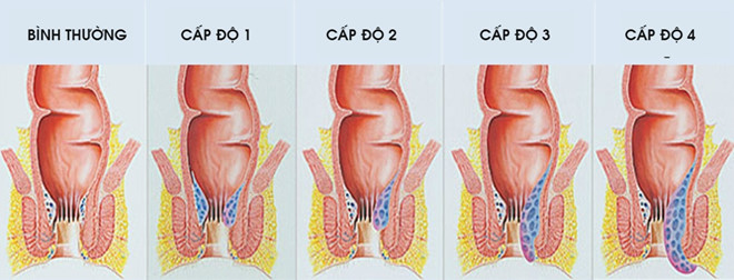 Các giai đoạn của bệnh trĩ nội