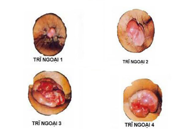 Các giai đoạn của bệnh trĩ ngoại