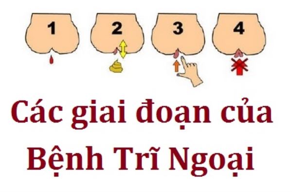 Các giai đoạn của bệnh trĩ ngoại