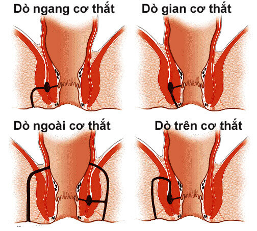 Rò hậu môn xuyên cơ thắt