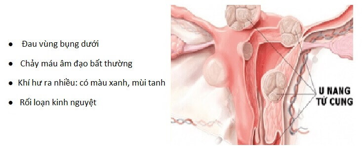 Các triệu chứng của bệnh u nang tử cung 