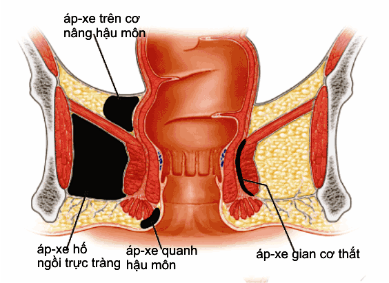 nắm bắt những thông tin cơ bản về áp xe hậu môn