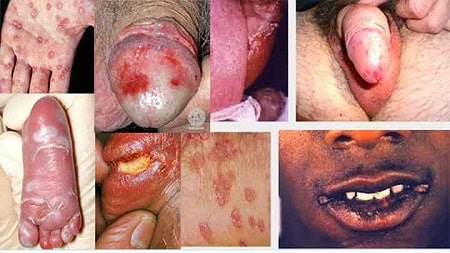 Điều trị bệnh giang mai khi nào ?