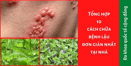 Cách chữa bệnh lậu ở nam giới bằng các bài mẹo tại nhà