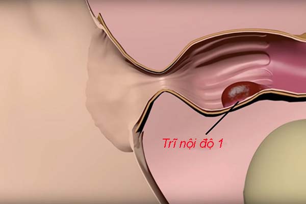 Tìm hiểu chung về bệnh trĩ nội độ 1