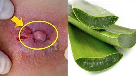 Bài thuốc dân gian chữa bệnh trĩ ngoại hiệu quả bằng gel lô hội 