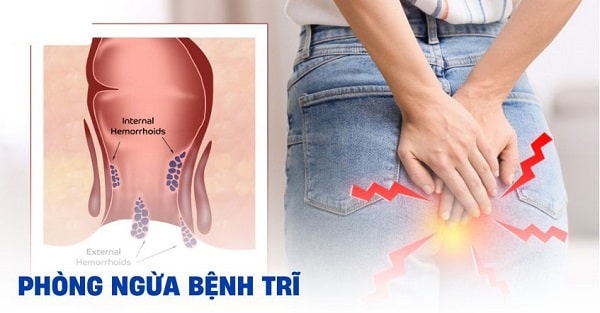 Tại sao cần phòng ngừa bệnh trĩ nội?