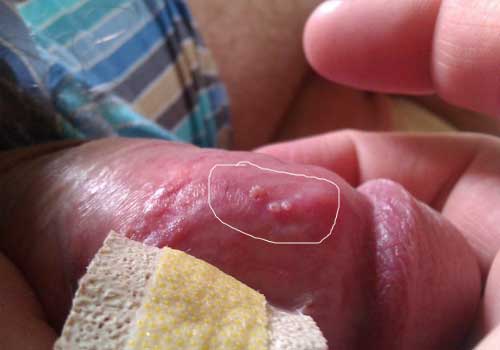 Mụn trắng bao quy đầu khiến nam giới khó chịu