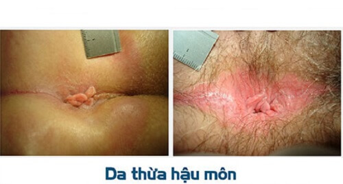 Cắt da thừa cạnh hậu môn