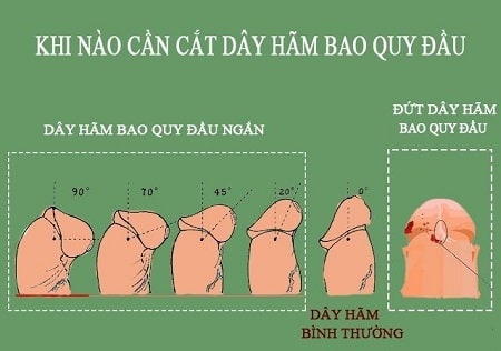 Có nên cắt dây hãm bao quy đầu hay không ?