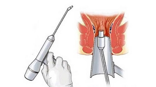 Cắt trĩ bằng laser