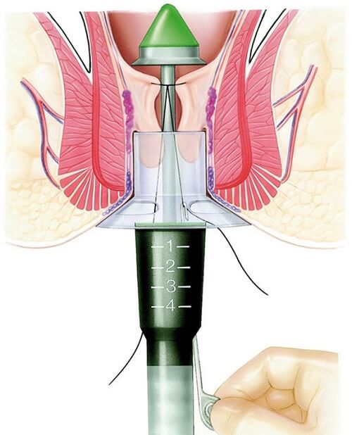Cắt trĩ bằng phương pháp Longo