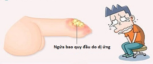 Cậu nhỏ bị sưng sau khi quan hệ - Do dị ứng