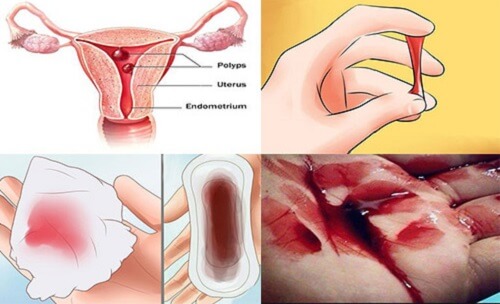 Đốt viêm lộ tuyến gây chảy máu cổ tử cung