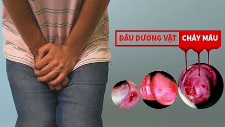 Lý giải hiện tượng chảy máu dương vật là bị làm sao?